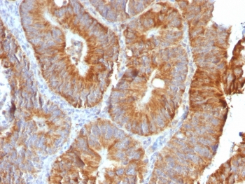 TNFSF15 Antibody Colon Carcinoma IHC. Immunohistochemistry staining of FFPE human colon carcinoma tissue using recombinant rabbit monoclonal clone VEGI/2052R demonstrates strong membranous and cytoplasmic HRP-DAB brown staining within gland-forming malignant epithelial cells, consistent with expression of TNFSF15 / VEGI in epithelial and inflammatory signaling-associated tissue compartments. The observed staining pattern supports the involvement of this TNF superfamily cytokine in tumor-associated immune regulation and vascular signaling pathways. Heat-induced epitope retrieval was performed by boiling sections in 10 mM Tris with 1 mM EDTA, pH 9, for 10-20 min followed by cooling at room temperature for 20 min prior to staining.