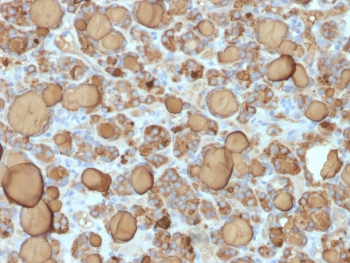 Thyroglobulin Antibody / TG Thyroid Follicular Cell Marker Antibody. Immunohistochemistry analysis of Thyroglobulin using Thyroglobulin Antibody Recombinant Rabbit MAb TGB/1968R in FFPE human thyroid carcinoma tissue section. HRP-DAB brown chromogenic staining highlights strong cytoplasmic signal in thyroid follicular tumor epithelial cells arranged in follicular structures, with prominent staining of follicular luminal colloid material reflecting abundant secreted Thyroglobulin. The staining pattern is characteristic of Thyroglobulin expression in thyroid follicular epithelial cells and supports its established role as a follicular lineage marker of thyroid epithelial differentiation.