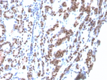 TF-1 Antibody Human Thyroid Tissue IHC. Formalin-fixed, paraffin-embedded human thyroid tissue stained using TTF-1 Antibody. The recombinant mouse monoclonal clone rNX2.1/690 antibody demonstrates strong nuclear staining in thyroid follicular epithelial cells, consistent with the nuclear localization of Thyroid transcription factor 1 (NKX2-1). NKX2-1 is a lineage-associated transcription factor expressed in thyroid follicular epithelium and pulmonary epithelial cells, and thyroid tissue therefore provides a well-established positive epithelial lineage control for TTF-1 antibody staining. In diagnostic immunohistochemistry, nuclear TTF-1 expression is widely used as a marker of pulmonary adenocarcinoma and other tumors derived from NKX2-1 expressing epithelial lineages. Required HIER: boil tissue sections in pH6 10mM citrate buffer for 10-20 min followed by cooling at RT for 20 min.