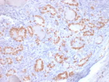 Immunohistochemistry of TTF-1 Antibody / Lung Adenocarcinoma Marker Antibody in human lung adenocarcinoma. Formalin-fixed, paraffin-embedded human lung adenocarcinoma tissue stained using TTF-1 Antibody / Lung Adenocarcinoma Marker Antibody. The recombinant mouse monoclonal clone rNX2.1/690 antibody shows strong nuclear immunoreactivity in malignant pulmonary epithelial cells, highlighting tumor cells of pulmonary origin. Nuclear staining of Thyroid transcription factor 1 (NKX2-1) is a well-established diagnostic feature of pulmonary adenocarcinoma and is widely used in immunohistochemistry panels to distinguish primary lung adenocarcinoma from metastatic carcinomas involving the lung. This staining pattern supports the role of TTF-1 as a lineage-defining pulmonary tumor marker and a key immunohistochemical marker for lung adenocarcinoma identification in surgical pathology. Required HIER: boil tissue sections in pH6 10mM citrate buffer for 10-20 min followed by cooling at RT for 20 min.