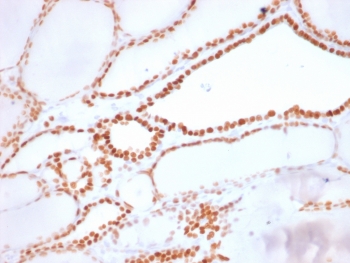 NKX2.1 Antibody / Forebrain Thyroid Development Marker Antibody (clone NX2.1/1855R). Immunohistochemistry analysis of human thyroid tissue. FFPE human thyroid sections demonstrate strong HRP-DAB brown nuclear staining in thyroid follicular epithelial cells lining the thyroid follicles, consistent with expression of the NKX2.1 developmental homeobox transcription factor. The nuclear staining pattern highlights NKX2.1 as a transcription factor involved in thyroid organogenesis and early thyroid epithelial lineage specification. Positive nuclei are distributed throughout follicular epithelial cells surrounding colloid-filled follicles, reflecting transcriptional programs associated with thyroid developmental regulation. This staining pattern is consistent with NKX2.1 activity as a marker of thyroid developmental lineage identity. Surrounding stromal elements show minimal staining. Required HIER: boil tissue sections in pH6, 10mM citrate buffer, for 10-20 minutes followed by cooling at room temperature for 20 minutes prior to antibody incubation.