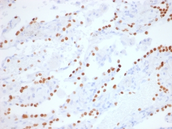 NKX2.1 Antibody Lung Adenocarcinoma IHC (clone NX2.1/1855R). Immunohistochemistry analysis of human lung adenocarcinoma tissue. FFPE human lung adenocarcinoma sections demonstrate strong HRP-DAB brown nuclear staining in tumor epithelial cells, consistent with expression of the NKX2.1 developmental homeobox transcription factor that participates in early lineage specification programs shared between lung and thyroid developmental pathways. Positive tumor cell nuclei are distributed throughout the carcinoma cell population, reflecting transcriptional programs associated with NKX2.1-mediated developmental regulation of epithelial lineage identity. The nuclear staining pattern highlights the role of NKX2.1 as a developmental transcription factor originally characterized in studies of ventral forebrain patterning and thyroid organogenesis. Surrounding stromal cells and non-epithelial elements show minimal staining. Required HIER: boil tissue sections in pH6, 10mM citrate buffer, for 10-20 minutes followed by cooling at room temperature for 20 minutes prior to antibody incubation.