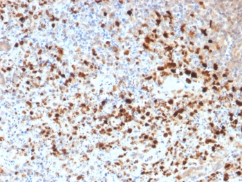 IHC staining of FFPE human cervix with HSV1 antibody (clone HSV1/1934). Required HIER: boil tissue sections in pH6, 10mM citrate buffer, for 10-20 min followed by cooling at RT for 20 min.