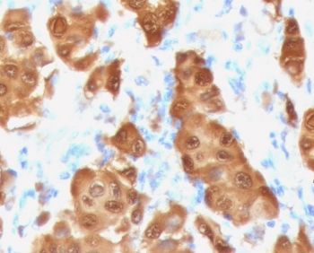 Immunohistochemistry analysis of S100B / Melanoma Marker antibody (clone PS1B1-2R) in human melanoma tissue. FFPE human melanoma demonstrates strong cytoplasmic and nuclear HRP-DAB brown staining in malignant melanocytic cells, consistent with S100B expression. Tumor cells show diffuse and intense staining, while surrounding stromal elements display comparatively weaker signal. Nuclei are counterstained blue. Heat induced epitope retrieval was performed by steaming sections in 10 mM Tris with 1 mM EDTA, pH 9.0, for 10-20 minutes prior to immunostaining.