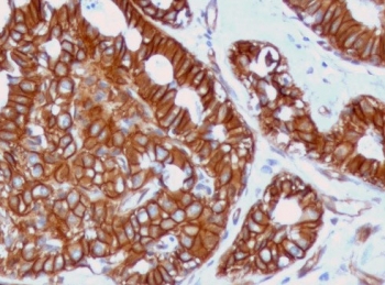 Beta Catenin Antibody Rabbit Monoclonal Immunohistochemistry. IHC staining of FFPE human breast cancer tissue with recombinant beta Catenin antibody (clone CTNB1-1R). Required HIER: boil tissue sections in 10mM Tris with 1mM EDTA, pH 9, for 10-20 min followed by cooling at RT for 20 min.