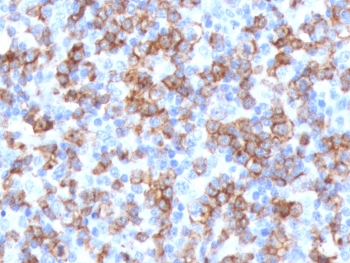 CD8A Antibody Tonsil IHC. Immunohistochemistry analysis of CD8 alpha (CD8A) in FFPE human tonsil tissue shows strong membranous staining of numerous cytotoxic T lymphocytes within lymphoid regions, consistent with CD8-positive tumor infiltrating lymphocyte marker expression and supporting identification of dense immune cell infiltration in lymphoid tissue. Heat-induced epitope retrieval was performed in 10 mM citrate buffer, pH 6.0, for 10-20 minutes followed by cooling at room temperature.