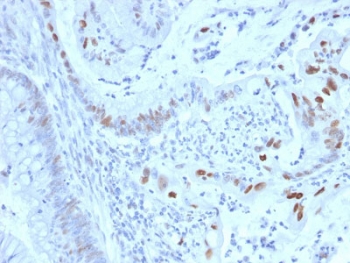 Cyclin E1 Antibody Human Colon Carcinoma IHC. Immunohistochemistry staining of FFPE human colon carcinoma tissue using Cyclin E1 Antibody / G1-S Cell Cycle Regulator Antibody (clone CCNE1/2460) demonstrates distinct nuclear HRP-DAB brown staining within scattered malignant epithelial cell populations. The predominantly nuclear staining pattern is consistent with expression of Cyclin E1 (CCNE1), a key regulator of the G1-S transition that promotes DNA replication through activation of CDK2-dependent cell cycle pathways. Detection of Cyclin E1 within proliferating tumor cells aligns with its established role in cellular proliferation, cell cycle progression, and regulation of growth-associated transcriptional programs. HIER: boil tissue sections in pH 6, 10 mM citrate buffer for 10-20 minutes followed by cooling at room temperature for 20 minutes before testing.