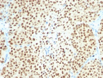 IHC testing of FFPE melanoma with SOX10/Melanocytic Lineage antibody (clone SOX10/2311R). Required HIER: boil sections in pH 9 10mM Tris with 1mM EDTA for 10-20 minutes, followed by cooling at RT for 20 minutes, prior to staining.