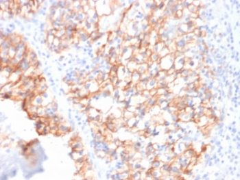 Cadherin 16 Antibody Renal Cell Carcinoma IHC. Immunohistochemical analysis of Cadherin-16 / CDH16 expression in formalin-fixed, paraffin-embedded human renal cell carcinoma using Cadherin 16 antibody clone CDH16/2125. Strong membranous staining is observed in tumor epithelial cells, highlighting well-defined cell-cell borders consistent with preserved epithelial adhesion features. The staining pattern supports kidney-specific expression and is consistent with CDH16 localization in renal tubular-derived tumor cells. Required HIER: boil tissue sections in 10mM citrate buffer, pH6, for 10-20 min followed by cooling at RT for 20 min.