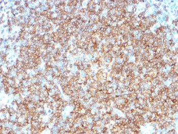 CD22 Antibody Tonsil IHC. Immunohistochemistry analysis of CD22/Siglec-2 expression in FFPE human tonsil tissue using CD22 Microarray Specificity Validated Antibody clone BLCAM/1795. Strong HRP-DAB brown membranous and cytoplasmic staining is observed in B cell-rich regions, highlighting dense populations of lymphocytes consistent with CD22 expression in mature B cells, while surrounding non-lymphoid tissue remains largely negative. The staining pattern supports use of this CD22 antibody for immunohistochemistry-based identification of B cell populations with high specificity. Heat-induced epitope retrieval was performed using citrate buffer (pH 6) for 10-20 minutes followed by cooling at room temperature prior to antibody incubation.