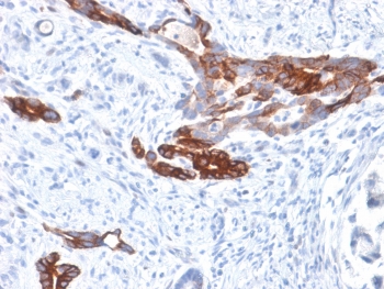Immunohistochemistry analysis of Gastric Mucin / MUC6 antibody (clone MUC6/1553R) in human gastric carcinoma tissue. FFPE human gastric carcinoma section shows cytoplasmic brown chromogenic staining in malignant glandular epithelial cells, consistent with MUC6 expression, while surrounding stromal elements exhibit minimal staining and nuclei appear blue. Heat-induced epitope retrieval was performed by boiling tissue sections in pH 9 10 mM Tris with 1 mM EDTA for 10-20 minutes followed by cooling at room temperature for 20 minutes prior to staining.