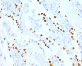 NKX2.1 Antibody Lung Adenocarcinoma IHC (clone HBNK2-2R). Immunohistochemistry analysis of human lung adenocarcinoma tissue. FFPE human lung adenocarcinoma sections demonstrate strong HRP-DAB brown nuclear staining in tumor epithelial cells, consistent with expression of the NKX2.1 thyroid transcription factor within pulmonary tumor cells. Positive nuclei are distributed throughout the carcinoma cell population, reflecting activation of NKX2.1-regulated epithelial transcriptional programs that are characteristic of this lineage transcription factor. The nuclear staining pattern highlights the role of NKX2.1 as a transcription factor that regulates epithelial gene expression programs associated with thyroid lineage transcriptional control. Surrounding stromal cells and non-epithelial elements show minimal staining. Required HIER: boil tissue sections in pH6, 10mM citrate buffer, for 10-20 minutes followed by cooling at room temperature for 20 minutes prior to antibody incubation.