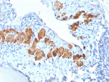 SMMHC Antibody Breast Carcinoma IHC. Immunohistochemical staining of FFPE human breast carcinoma demonstrates expression of Smooth Muscle Myosin Heavy Chain using recombinant SMMHC antibody clone MYH11/2303R. SMMHC, encoded by the MYH11 gene, is a highly specific marker of differentiated smooth muscle and myoepithelial cells. Strong cytoplasmic staining highlights residual myoepithelial cells surrounding glandular structures, consistent with the utility of SMMHC in distinguishing invasive from in situ breast lesions. Heat induced epitope retrieval was performed by boiling tissue sections in pH 9 10 mM Tris with 1 mM EDTA for 10-20 minutes followed by cooling at room temperature for 20 minutes. These results support the utility of SMMHC Antibody for studies of myoepithelial differentiation, breast pathology, and smooth muscle biology.