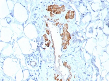 SMMHC Antibody Breast Myoepithelium IHC. Immunohistochemical staining of FFPE human breast carcinoma demonstrates Smooth Muscle Myosin Heavy Chain expression using SMMHC antibody clone MYH11/2303R. SMMHC, encoded by MYH11, is a highly specific marker of mature smooth muscle and myoepithelial differentiation. Strong cytoplasmic staining is observed in myoepithelial cells surrounding ductal structures within adipose-rich breast tissue, while adjacent stromal elements remain largely negative. This staining pattern highlights the value of SMMHC in identifying intact myoepithelial layers and aiding in the distinction between invasive and noninvasive breast lesions. Heat induced epitope retrieval was performed by boiling tissue sections in pH 9 10 mM Tris with 1 mM EDTA for 10-20 minutes followed by cooling at room temperature for 20 minutes. These results support the utility of SMMHC Antibody for studies of breast pathology, myoepithelial biology, and smooth muscle differentiation.