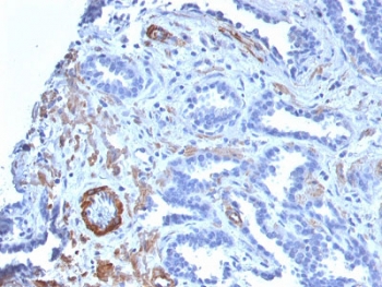 SMMHC Antibody Prostate Carcinoma IHC. Immunohistochemical staining of FFPE human prostate carcinoma demonstrates Smooth Muscle Myosin Heavy Chain expression using SMMHC antibody clone MYH11/2303R. SMMHC, encoded by the MYH11 gene, is a highly specific marker of differentiated smooth muscle and prostatic basal-associated stromal elements. Distinct cytoplasmic staining highlights smooth muscle bundles and vascular walls surrounding malignant glands, while neoplastic epithelial cells show little to no reactivity. Preservation or loss of SMMHC-positive structures provides valuable information in the histopathologic evaluation of prostatic lesions. Heat induced epitope retrieval was performed by boiling tissue sections in pH 9 10 mM Tris with 1 mM EDTA for 10-20 minutes followed by cooling at room temperature for 20 minutes. These results support the utility of SMMHC Antibody for studies of prostate pathology, smooth muscle differentiation, and stromal architecture.
