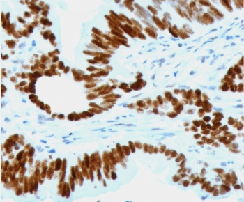 p53 Antibody Clone CTA53-2R / TP53 Tumor Suppressor Antibody. Immunohistochemistry analysis of FFPE human colon carcinoma tissue demonstrates strong nuclear staining of tumor epithelial cells using p53 Antibody Clone CTA53-2R. The HRP-DAB brown chromogenic signal highlights nuclear localization of Tumor protein p53 within malignant epithelial cells, while surrounding stromal cells show comparatively weaker staining. Heat-induced epitope retrieval was performed by boiling tissue sections in pH6 10 mM citrate buffer for 10-20 minutes followed by cooling at room temperature for 20 minutes prior to staining.