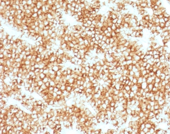 Parathyroid Hormone IHC Antibody immunohistochemistry analysis of PTH in human parathyroid gland tissue. FFPE human parathyroid gland tissue was stained using Parathyroid Hormone antibody clone PRTM1-1R following heat induced epitope retrieval by steaming sections in pH 9 Tris-EDTA buffer (10mM Tris, 1mM EDTA) for 10-20 minutes prior to staining. HRP-DAB brown chromogenic signal highlights strong cytoplasmic staining in parathyroid endocrine chief cells, consistent with the known localization of Parathyroid hormone (PTH), a key regulator of calcium homeostasis produced by parathyroid gland cells. The staining pattern demonstrates robust detection of hormone-producing parathyroid tissue and supports the use of Parathyroid Hormone IHC Antibody / PTH Antibody (clone PRTM1-1R) for immunohistochemistry analysis of PTH expression in FFPE tissue sections.