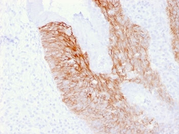 CD44v6 Antibody for IHC Cervical Carcinoma. Immunohistochemistry analysis of CD44 variant 6 / CD44 expression in FFPE human cervix carcinoma using mouse monoclonal antibody clone 2F10. Strong membranous HRP-DAB brown staining is observed in malignant epithelial cells, outlining tumor nests and highlighting cell surface localization consistent with CD44v6-associated adhesion, tumor invasion, and metastatic potential. The staining pattern emphasizes carcinoma cell organization and supports its role in invasive behavior and progression within cervical cancer tissue. Heat induced epitope retrieval was performed by boiling tissue sections in pH 9 10mM Tris with 1mM EDTA for 20 min followed by cooling at RT before testing.