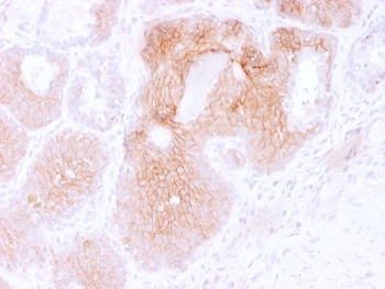 CD44v6 Antibody for IHC Prostate Carcinoma. Immunohistochemistry analysis of CD44 variant 6 / CD44 expression in FFPE human prostate carcinoma using mouse monoclonal antibody clone 2F10. Distinct membranous HRP-DAB brown staining is observed in malignant epithelial cells forming glandular tumor structures, highlighting cell surface localization consistent with CD44v6-associated adhesion, tumor invasion, and metastatic potential. The staining pattern demonstrates heterogeneous expression across tumor glands, supporting its relevance for evaluating tumor organization, invasive behavior, and progression-associated changes in prostate carcinoma tissue. Heat induced epitope retrieval was performed by boiling tissue sections in pH 9 10mM Tris with 1mM EDTA for 20 min followed by cooling at RT before testing.