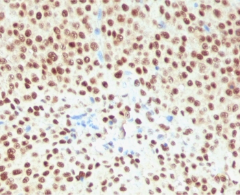 IHC staining of FFPE human melanoma tissue with HMG-box Transcription Factor/SOX10 antibody (clone SBX10-2R). Required HIER: boil sections in pH 9 10mM Tris with 1mM EDTA for 10-20 minutes, followed by cooling at RT for 20 minutes, prior to staining.