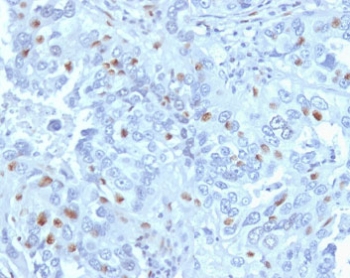 Immunohistochemistry analysis of CCNA2 / Cyclin A2 antibody (clone CNA2-1) in human endometrial carcinoma tissue. Formalin-fixed, paraffin-embedded human endometrial carcinoma tissue was stained using CCNA2 antibody (clone CNA2-1). Heat-induced epitope retrieval was performed by steaming tissue sections in citrate buffer, pH 6.0, for 20 minutes, followed by cooling prior to antibody incubation. Brown chromogenic signal is observed predominantly in the nuclei of scattered tumor epithelial cells, consistent with proliferative cell populations, while surrounding stromal cells show minimal staining. This nuclear staining pattern reflects cell cycle-associated expression of Cyclin A2 in endometrial carcinoma.