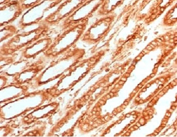 IHC testing of FFPE human renal cell carcinoma with Calnexin antibody (clone CLNXN-1). HIER: boil tissue sections in pH 9 10mM Tris with 1mM EDTA for 10-20 min followed by cooling at RT for 20 min. 