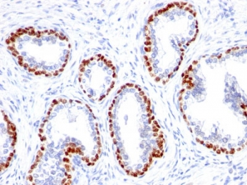 Immunohistochemistry analysis of p63 expression. Recombinant p63 antibody (clone TP63/1423R) staining was performed on formalin-fixed, paraffin-embedded human prostate cancer tissue, showing strong nuclear DAB signal in basal-type epithelial cells, with surrounding stromal cells largely negative and hematoxylin counterstaining. Heat-induced epitope retrieval was carried out by boiling tissue sections in Tris buffer (10 mM, pH 9.0) containing EDTA (1 mM) for 10-20 minutes, followed by cooling at room temperature for 20 minutes, with signal detection using an HRP-conjugated secondary antibody and DAB chromogen.