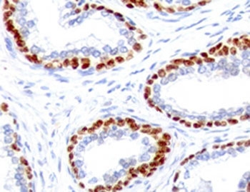 Immunohistochemistry analysis of p63 expression. Recombinant TP63 antibody (clone TMPR63-1R) staining was performed on formalin-fixed, paraffin-embedded human prostate cancer tissue, showing nuclear DAB-positive staining in basal-type epithelial cells lining glandular structures, with surrounding stromal cells largely negative and hematoxylin counterstaining. Heat-induced epitope retrieval was carried out by boiling tissue sections in Tris buffer (10 mM, pH 9.0) containing EDTA (1 mM) for 10-20 minutes, followed by cooling at room temperature for 20 minutes, with signal detection using an HRP-conjugated secondary antibody and DAB chromogen.