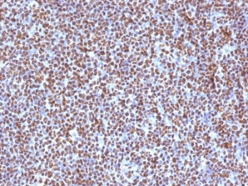 ALK Antibody ALCL IHC. Immunohistochemistry staining of FFPE human anaplastic large-cell lymphoma tissue using monoclonal clone ALK/1504 demonstrates strong diffuse nuclear and cytoplasmic HRP-DAB brown staining throughout neoplastic lymphoid cells, consistent with ALK fusion-associated protein expression in ALK-positive lymphoma. The widespread staining pattern supports activation of oncogenic ALK signaling pathways characteristic of anaplastic large-cell lymphoma biology. HIER: boil tissue sections in pH6, 10mM citrate buffer, for 10-20 min followed by cooling at room temperature for 20 min.