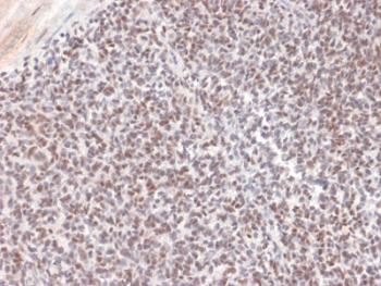 ALK Antibody Ewing Sarcoma IHC. Immunohistochemistry staining of FFPE human Ewing's sarcoma tissue using monoclonal clone ALK/1504 reveals widespread nuclear and cytoplasmic HRP-DAB brown staining in malignant small round tumor cells. The observed staining distribution supports detection of ALK-associated signaling protein expression within sarcoma-derived neoplastic tissue compartments. HIER: boil tissue sections in pH6, 10mM citrate buffer, for 10-20 min followed by cooling at room temperature for 20 min.