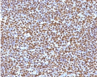 ALK Antibody Lymphoma Cell Marker IHC. Immunohistochemistry staining of FFPE human anaplastic large-cell lymphoma tissue using monoclonal clone ATKR-1 demonstrates extensive nuclear and cytoplasmic HRP-DAB brown staining in neoplastic lymphoid cells, highlighting the characteristic ALK-associated staining profile observed in ALK-positive lymphoma. The intense tumor cell labeling supports detection of oncogenic ALK fusion protein expression within lymphoma-associated cellular populations. HIER: boil tissue sections in pH6, 10mM citrate buffer, for 10-20 min followed by cooling at room temperature for 20 min.