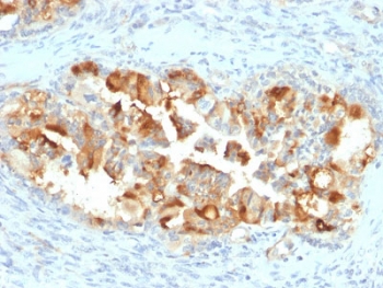 Mesothelin Antibody Endometrial Carcinoma IHC. Immunohistochemistry analysis of mesothelin expression in FFPE human endometrial carcinoma using clone MSLN/2131. Tumor epithelial cells demonstrate membranous HRP-DAB brown staining with focal cytoplasmic signal, consistent with mesothelin surface localization and processing. Staining highlights glandular tumor structures, while surrounding stromal components show minimal reactivity, supporting its role as a tumor marker in epithelial malignancies. Heat-induced epitope retrieval was performed using pH 9 Tris-EDTA buffer.