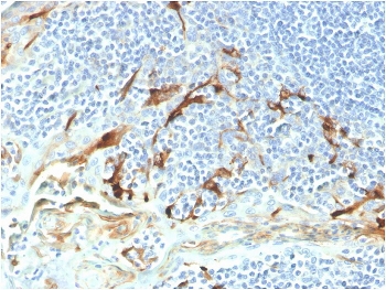 Biotinylated Mesothelin Antibody Endometrial Carcinoma IHC. Immunohistochemistry analysis of mesothelin expression in FFPE human endometrial carcinoma using biotinylated clone MSLN/2131. Tumor epithelial cells demonstrate membranous HRP-DAB brown staining with focal cytoplasmic signal, consistent with mesothelin surface localization. The biotinylated detection format enables enhanced signal intensity and improved visualization of tumor cell populations, particularly in regions with lower expression, while surrounding stromal elements remain low in background staining. Heat-induced epitope retrieval was performed using pH 9 Tris-EDTA buffer.