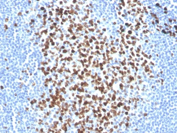 Ki-67 Antibody Biotin Conjugate / MKI67 Biotinylated Antibody (clone MKI67/2465). Immunohistochemistry analysis of FFPE human tonsil tissue using Ki-67 Antibody Biotin Conjugate (clone MKI67/2465). Strong nuclear brown staining is observed in numerous proliferating lymphoid cells within the germinal center region of the tonsil, consistent with the known expression pattern of Ki-67 / MKI67 in actively dividing cells. The biotin-conjugated antibody format enables detection through avidin-biotin based staining systems, producing clear nuclear labeling of proliferating lymphocytes within the lymphoid follicle. Heat-induced epitope retrieval was performed by boiling tissue sections in pH 9 10mM Tris with 1mM EDTA for 20 minutes followed by cooling prior to staining.