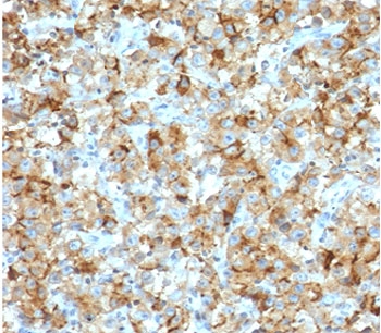 StAR Antibody Adrenal Marker (clone SARP1-1). Immunohistochemistry analysis of Steroidogenic Acute Regulatory Protein (StAR / STARD1) in FFPE human testicular carcinoma tissue using a mouse monoclonal antibody. HRP-DAB brown cytoplasmic staining highlights tumor cells with steroidogenic differentiation, consistent with the mitochondrial localization of StAR in steroid hormone-producing endocrine cells, while surrounding stromal and non-steroidogenic tissues show minimal staining. Heat-induced epitope retrieval was performed by boiling tissue sections in pH 9 Tris-EDTA buffer (10 mM Tris with 1 mM EDTA) for 10-20 minutes followed by cooling at room temperature for 20 minutes prior to staining.