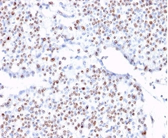 IHC staining of FFPE human bladder with TCF4 antibody (clone TCF4/1705). HIER: boil tissue sections in pH 9 10mM Tris with 1mM EDTA for 20 min and allow to cool before testing.