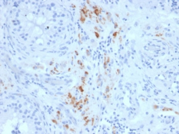 StAR Antibody Protein Microarray Validated Clone STAR/2140. Immunohistochemistry analysis of Steroidogenic Acute Regulatory Protein (StAR / STARD1) in FFPE human testicular carcinoma tissue using a mouse monoclonal antibody validated by protein microarray specificity screening. HRP-DAB brown cytoplasmic staining highlights tumor cells with steroidogenic differentiation, consistent with the mitochondrial localization of StAR in steroid hormone-producing cells, while surrounding stromal and non-steroidogenic tissues show minimal staining. Heat-induced epitope retrieval was performed by boiling tissue sections in 10 mM citrate buffer, pH 6, for 10-20 minutes followed by cooling at room temperature for 20 minutes prior to staining.