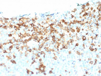 IHC testing of FFPE human melanoma tissue with NGF Receptor antibody (clone NGFR/1964). HIER: boil tissue sections in pH6, 10mM citrate buffer, for 10-20 min followed by cooling at RT for 20 min.