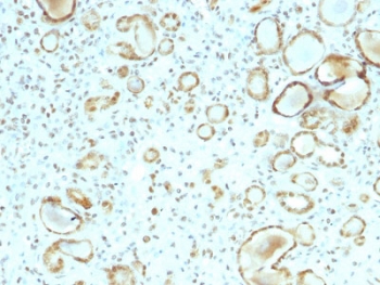 Immunohistochemistry analysis of STAT3 antibody in human renal cell carcinoma tissue (clone STAT6/2410). FFPE human renal cell carcinoma sections demonstrate HRP-DAB brown cytoplasmic and nuclear staining in tumor cells forming glandular and tubular structures. The staining pattern highlights both cytoplasmic localization and nuclear accumulation consistent with activated Signal transducer and activator of transcription 3 in neoplastic epithelial cells. Surrounding stromal components show minimal background staining. Heat induced epitope retrieval was performed in pH 6, 10 mM citrate buffer by boiling tissue sections for 10-20 minutes followed by cooling at room temperature for 20 minutes prior to antibody incubation.