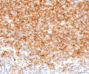 Immunohistochemistry of CD40 antibody in human tonsil tissue. FFPE human tonsil shows strong membranous and cytoplasmic HRP-DAB brown staining in lymphoid cells within germinal centers and interfollicular regions, consistent with CD40 expression in B lymphocytes and antigen-presenting cells. This CD40 Antibody for IHC, clone CDLA40-1, was used following heat-induced epitope retrieval by boiling tissue sections in 10 mM citrate buffer, pH 6, for 10-20 minutes prior to staining.