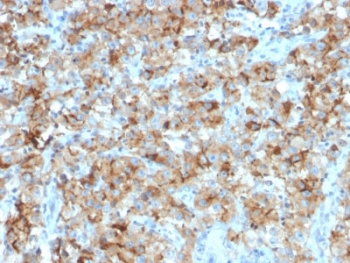 StAR Antibody Microarray Specificity Validated Clone STAR/2154. Immunohistochemistry analysis of Steroidogenic Acute Regulatory Protein (StAR / STARD1) in FFPE human testicular carcinoma tissue using a mouse monoclonal antibody validated by large-scale protein microarray specificity screening. HRP-DAB brown cytoplasmic staining highlights tumor cells with steroidogenic differentiation, consistent with the mitochondrial localization of StAR in steroid hormone-producing cells, while surrounding stromal and non-steroidogenic tissues show minimal staining. Heat-induced epitope retrieval was performed by boiling tissue sections in pH 9 Tris-EDTA buffer (10 mM Tris with 1 mM EDTA) for 10-20 minutes followed by cooling at room temperature for 20 minutes prior to staining.