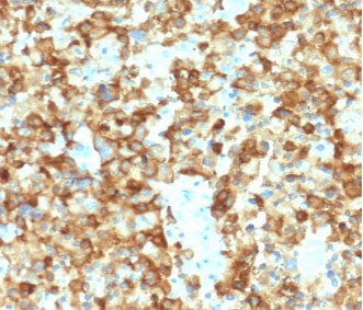Immunohistochemistry analysis of Melanoma gp100 antibody in human melanoma tissue. FFPE human melanoma sections show strong HRP-DAB brown cytoplasmic and membranous staining in tumor cells, consistent with premelanosome-associated localization of PMEL protein in melanocytic cells. Staining is observed in cohesive nests and sheets of melanoma cells, while surrounding stromal components show minimal background signal. Heat induced epitope retrieval was performed in 10 mM Tris with 1 mM EDTA, pH 9.0, by boiling for 10-20 minutes followed by cooling at room temperature for 20 minutes prior to antibody incubation.