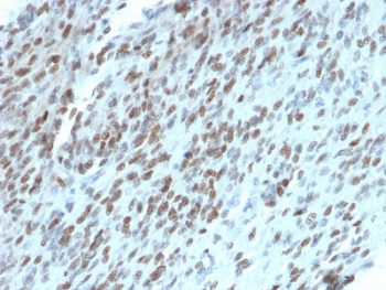 TLE1 Antibody Protein Microarray Validated Clone TLE1/2062 immunohistochemistry analysis of human gastrointestinal stromal tumor (GIST). Formalin-fixed paraffin-embedded human GIST tissue shows nuclear staining in tumor cells consistent with expression of Transducin-Like Enhancer Protein 1, a nuclear transcriptional corepressor belonging to the Groucho/TLE family of transcriptional regulators. Clone TLE1/2062 is a protein microarray validated antibody, indicating specificity assessment using large-scale protein microarray screening to evaluate antibody binding across extensive protein panels. Nuclear staining highlights tumor cells within the gastrointestinal stromal tumor while surrounding stromal elements show weaker or absent signal. Heat-induced epitope retrieval was performed by boiling tissue sections in pH 9 Tris-EDTA buffer for 10-20 minutes followed by cooling at room temperature prior to antibody staining.