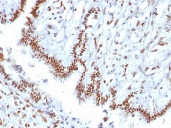 TLE1 Antibody Microarray Specificity Validated Clone TLE1/2085 immunohistochemistry analysis of human endometrial carcinoma. Formalin-fixed paraffin-embedded human endometrial carcinoma tissue shows strong nuclear staining in tumor epithelial cells consistent with expression of Transducin-Like Enhancer Protein 1, a nuclear transcriptional corepressor belonging to the Groucho/TLE family of transcriptional regulators. Clone TLE1/2085 is a Microarray Specificity Validated antibody, indicating antibody selectivity was assessed using proteome-scale protein microarray screening to evaluate binding across thousands of individual proteins and confirm preferential recognition of the intended target protein. Nuclear staining highlights malignant epithelial cells while surrounding stromal components show weaker or minimal signal. Heat-induced epitope retrieval was performed by boiling tissue sections in pH 9 Tris-EDTA buffer for 10-20 minutes followed by cooling at room temperature prior to antibody staining.
