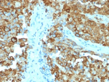 Immunohistochemistry analysis of Melanoma gp100 antibody in human melanoma tissue. FFPE human melanoma sections show strong HRP-DAB brown cytoplasmic and membranous staining in tumor cells, consistent with premelanosome-associated localization of PMEL protein in melanocytic cells. Staining highlights cohesive nests and sheets of melanoma cells, while adjacent stromal regions show minimal background signal. Heat induced epitope retrieval was performed in 10 mM Tris with 1 mM EDTA, pH 9.0, by boiling for 10-20 minutes followed by cooling at room temperature for 20 minutes prior to antibody incubation.