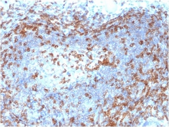 ZAP70 Antibody / Lymphocyte Development Signaling Antibody. Immunohistochemistry analysis of formalin-fixed, paraffin-embedded human lymph node tissue using ZAP70 Antibody / Lymphocyte Development Signaling Antibody (clone ZAP70/2046). Antigen retrieval was performed by boiling sections in pH 9 Tris-EDTA buffer for 10-20 minutes followed by cooling at room temperature. Cytoplasmic HRP-DAB brown staining is observed in lymphoid cell populations within cortical and paracortical regions, consistent with Zeta-chain-associated protein kinase 70 (ZAP70) expression in developing and mature lymphocytes. The staining pattern highlights organized lymphoid compartments and supports the role of ZAP70 in signaling pathways that regulate lymphocyte maturation, selection, and immune system development within lymphoid tissue architecture.