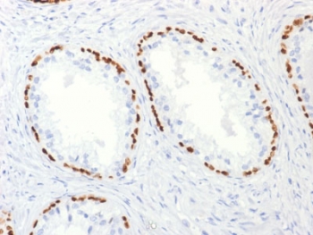 p63 Antibody Prostate Cancer Marker IHC. Immunohistochemistry analysis of Tumor protein 63 (TP63) in FFPE human prostate carcinoma tissue using a p63 antibody as a prostate cancer marker (clone TP63/2427) demonstrates distinct HRP-DAB brown nuclear staining in residual basal cells outlining benign glands, while malignant glandular epithelial cells remain negative. The continuous basal cell layer is clearly visible in non-neoplastic glands, forming a ring-like nuclear staining pattern, whereas carcinoma glands lack this basal cell staining, reflecting loss of basal epithelial architecture. This contrast provides a clear visual distinction between benign and malignant structures within the same tissue section. The nuclear-restricted signal with low background supports accurate interpretation of TP63 expression and reinforces its role as a marker of basal cell integrity in prostate tissue. Heat-induced epitope retrieval was performed by boiling tissue sections in pH 9 10mM Tris with 1mM EDTA for 10-20 minutes followed by cooling at room temperature for 20 minutes prior to antibody incubation.