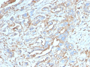 PD-L1 Antibody Breast Carcinoma IHC. Immunohistochemistry analysis of PD-L1 (CD274) expression in FFPE human breast carcinoma using clone PDL1/2746. The antibody demonstrates membranous HRP-DAB brown staining in tumor epithelial cells with additional signal in tumor-associated immune cells, highlighting immune checkpoint activity within the tumor microenvironment. The staining pattern shows heterogeneous expression across tumor regions, supporting evaluation of tumor-immune interactions and PD-L1-associated signaling. Heat-induced epitope retrieval was performed using pH 9 Tris-EDTA buffer.