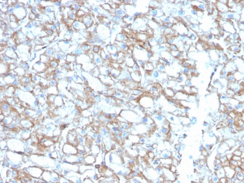 PD-L1 Biotinylated Antibody Lung Carcinoma IHC. Immunohistochemistry analysis of PD-L1 (CD274) expression in FFPE human lung carcinoma using biotin-conjugated clone PDL1/2746. The antibody demonstrates membranous HRP-DAB brown staining in tumor epithelial cells with additional signal in tumor-associated immune cells, consistent with immune checkpoint activity within the tumor microenvironment. Biotin-streptavidin amplification enhances detection of both strong and lower-level PD-L1 expression, supporting improved visualization of heterogeneous staining across tumor regions. Heat-induced epitope retrieval was performed using pH 9 Tris-EDTA buffer.