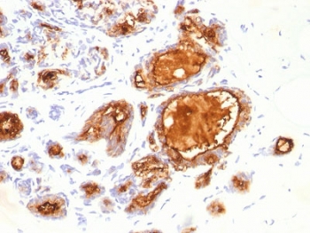 IHC testing of FFPE human breast carcinoma with MUC1 antibody (clone 115D8). HIER: requires steaming of sections in pH 9 10mM Tris with 1mM EDTA for 10-20 min.